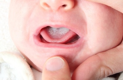 Acoperirea albă a limbii sugarilor a alăptat (în gura copilului)