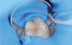 Gyors és kiszámítható helyreállítási fogak oldalcsoportján