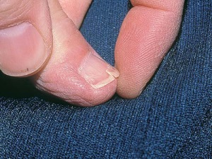 Ce se poate face dacă unghiile sunt tăiate din principalele metode de rezolvare a problemei pachetului de unghii