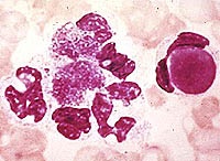 Mi a szisztémás lupus erythematosus, reumatológia, szisztémás lupus erythematosus