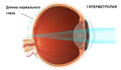 Hyperopia, tratamentul hipermetropiei la copiii din Novosibirsk în ochiul clinicii