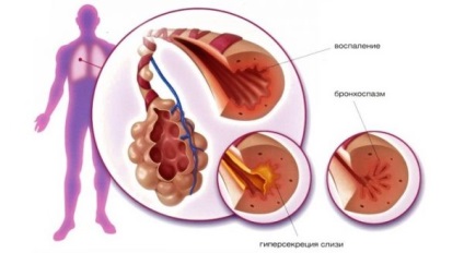 Respirația în astmul bronșic cu complicații sub formă de atacuri de astm