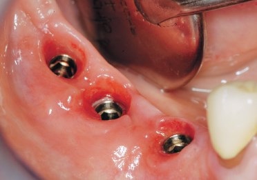 Tehnica cu două straturi de impresie în proteze pe implanturi