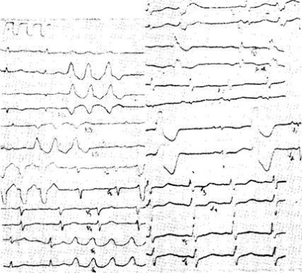 EKG jobb kamrai hipertrófia