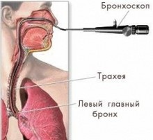 Metode endoscopice de diagnosticare a tuberculozei