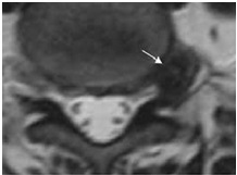 Îndepărtarea percutanată endoscopică a herniilor foraminal și extraforaminal ale discului