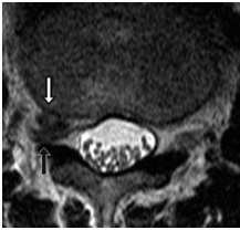 Îndepărtarea percutanată endoscopică a herniilor foraminal și extraforaminal ale discului