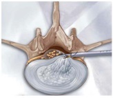 Îndepărtarea percutanată endoscopică a herniilor foraminal și extraforaminal ale discului