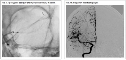 Tratamentul endovascular al istoricului dezvoltării AVC ischemice și prima experiență - consilium medicum №1