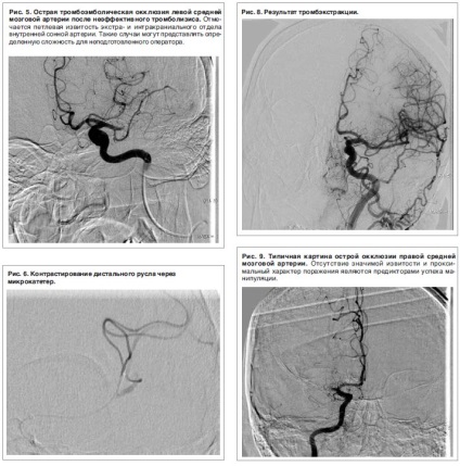 Tratamentul endovascular al istoricului dezvoltării AVC ischemice și prima experiență - consilium medicum №1