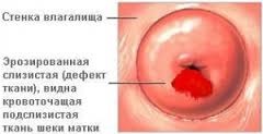 Eroziunea cervixului în fecioare