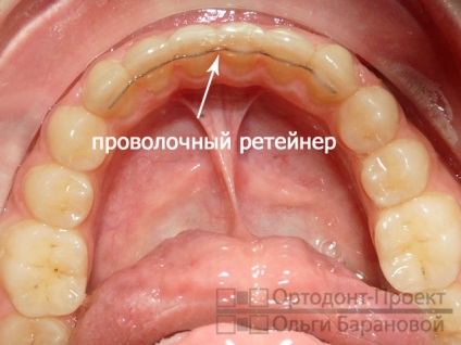 Etapele tratamentului ortodontic în cadrul proiectului ortodontic