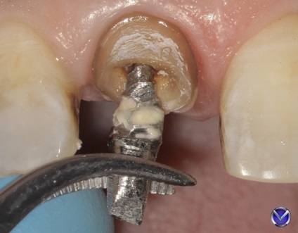 Photo zirconium coroana inserție tratament extracție cu microscop