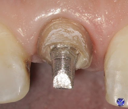 Photo zirconium coroana inserție tratament extracție cu microscop