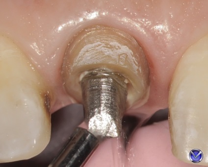 Photo zirconium coroana inserție tratament extracție cu microscop