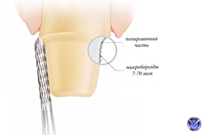 Photo zirconium coroana inserție tratament extracție cu microscop