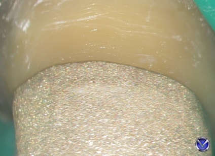 Photo zirconium coroana inserție tratament extracție cu microscop