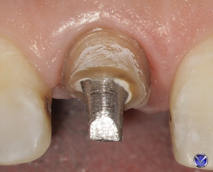 Photo zirconium coroana inserție tratament extracție cu microscop