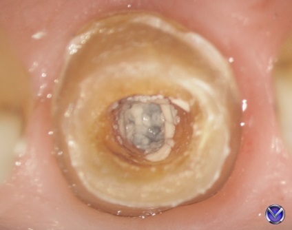 Photo zirconium coroana inserție tratament extracție cu microscop