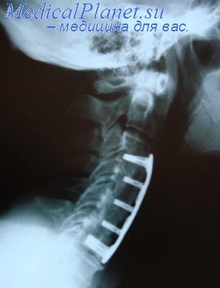 Metoda funcțională de tratament a fracturilor vertebrale