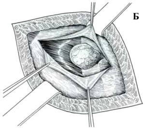 Herniation line spigelia, simptome și diagnostic, tratament