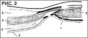 Herniile liniei de spihelium