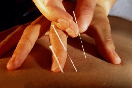 Acupunctura pentru pierderea in greutate - recenzii despre acupunctura pentru pierderea in greutate la Moscova, preturi, clinica