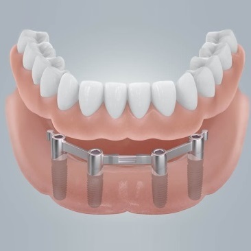 Az implantáció hiányában fogak