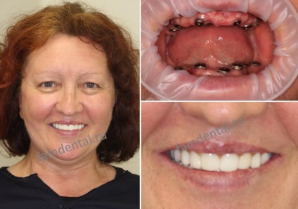 Implantarea cu absenta completa a dintilor