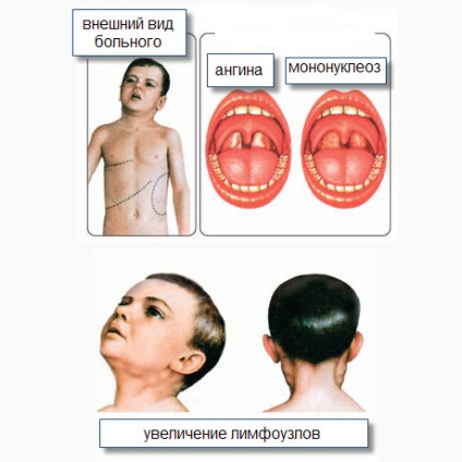 Infecțioase cauze și simptome de mononucleoză, eurolab, boli infecțioase