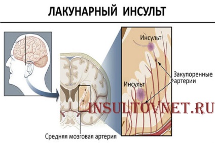 Dieta și prognosticul vascular cerebral ischemic
