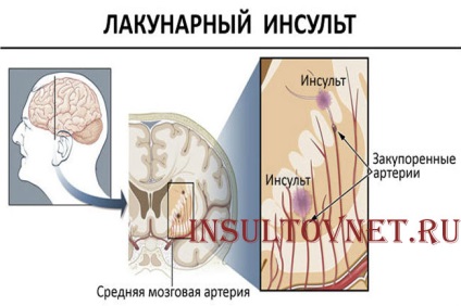 Исхемичен инсулт и прогноза диета