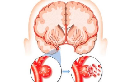 Cum se face masajul după un accident vascular cerebral - tratament cardiac