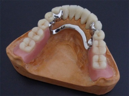 Ce sunt protezele dentare demontabile și care nu pot fi îndepărtate