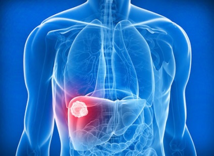 Care sunt semnele, tratamentul și prognosticul cancerului hepatic primar?