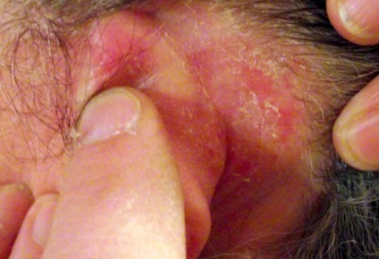 Ce boli provoacă prurit în urechi