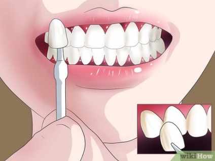 Hogyan fehéríti a fogakat