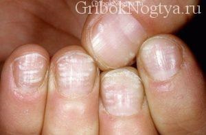 Cum arată ciuperca unghiilor pe mâini