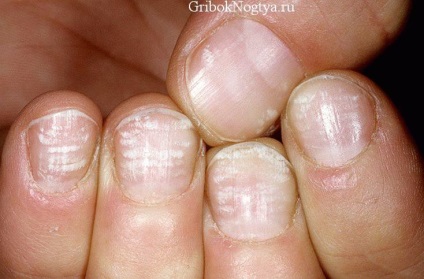 Cum arată ciuperca unghiilor pe mâini