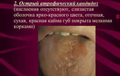 Orális candidiasis tünetei felnőtteknél és a kezelés