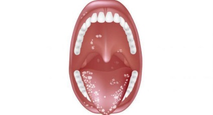 Candidoza cavității orale la adulți cu simptome și tratament