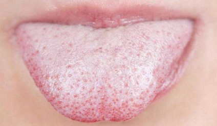 Orális candidiasis tünetei felnőtteknél és a kezelés