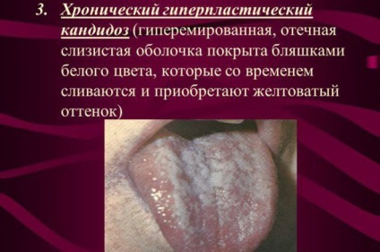 Candidoza cavității orale la adulți cu simptome și tratament