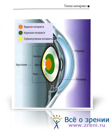 Imagini clinice ale cataractei