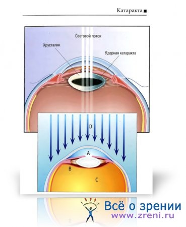 Imagini clinice ale cataractei