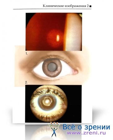 Imagini clinice ale cataractei
