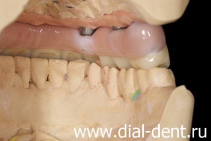 Proteza dentară cu alergie din plastic