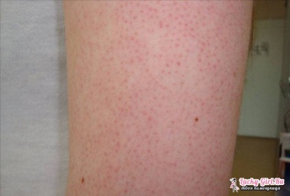 bőr keratosis