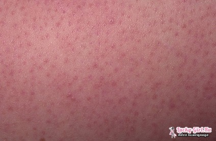 bőr keratosis