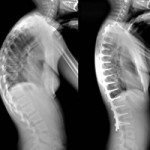 Cifoza coloanei vertebrale toracice